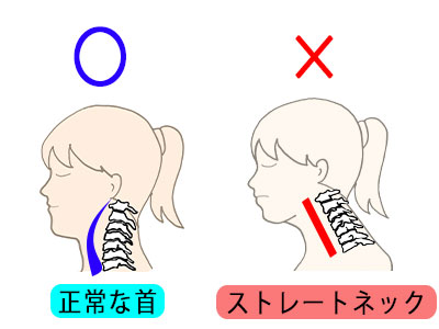 ストレートネックの説明